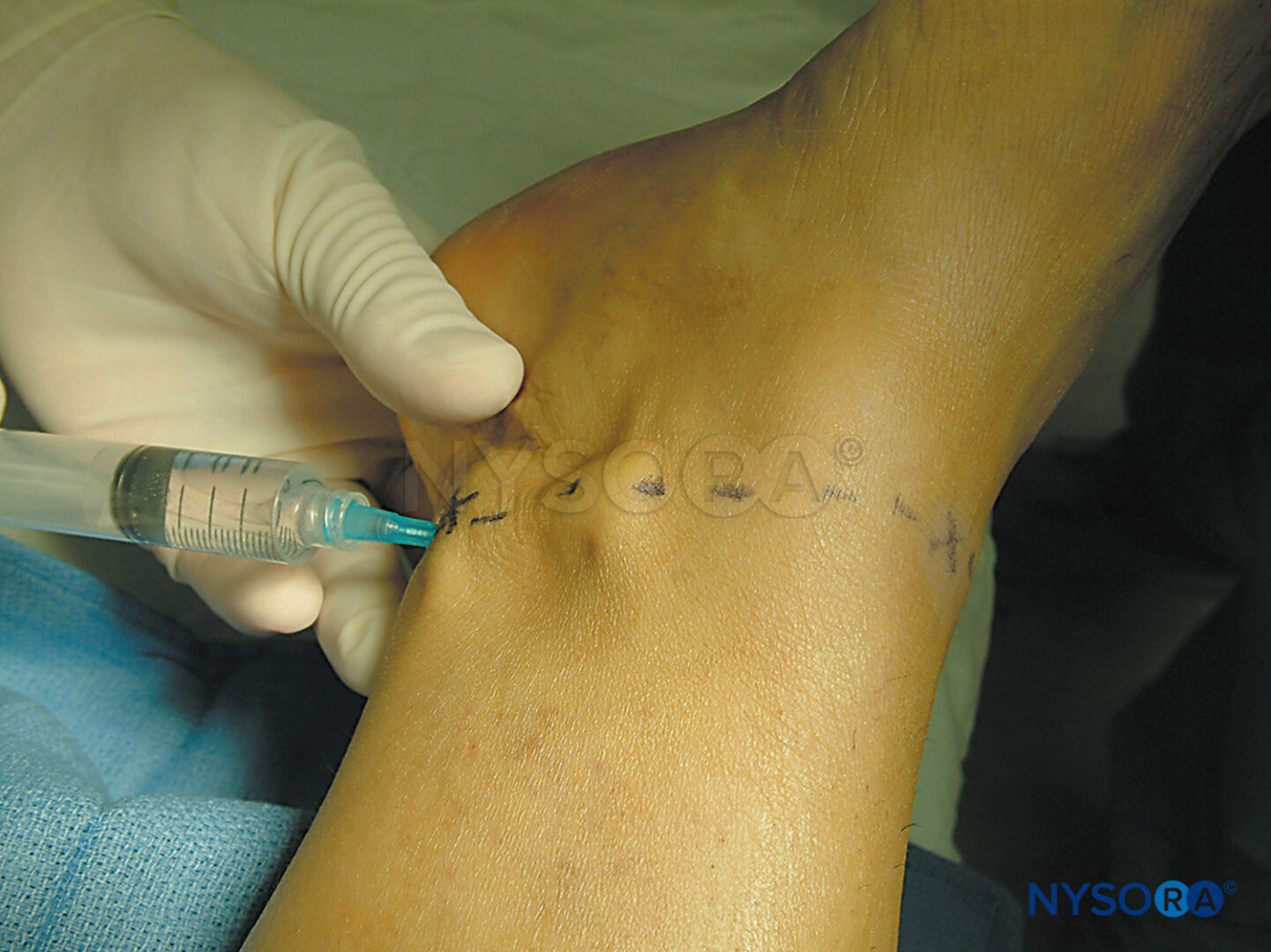 Are ankle blocks a painful procedure? Get the facts about what to expect during the injection.