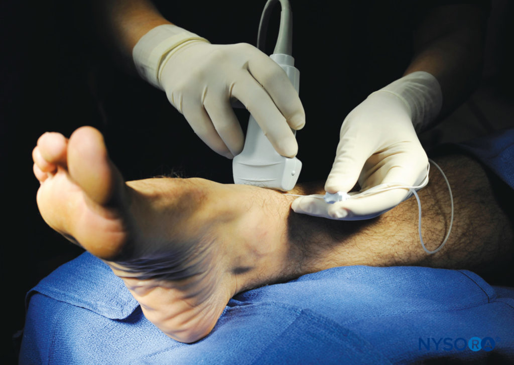 Are ankle blocks a painful procedure? Get the facts about what to expect during the injection.